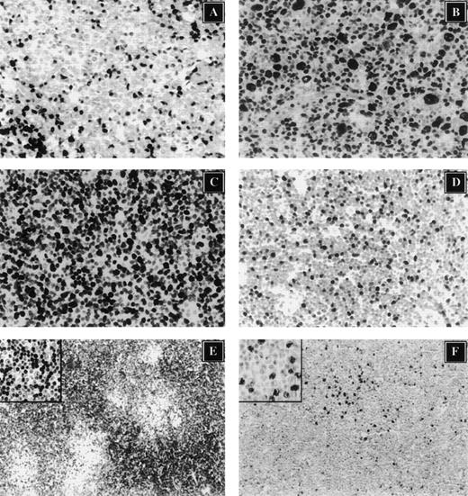 Fig. 2. Immunohistochemical characterization of cell cycle regulators in non-Hodgkin's lymphoma. / (A) p27 expression analysis in l-MCL demonstrates that the neoplastic cells are negative and that rare intratumor reactive cells show strong nuclear reactivity. (B) The same case also shows overexpression of p53. The expression of Ki-67 (C) in l-MCL and E2F-1 (s-MCL, Panel D) are shown. (E) p27 is highly expressed in resting CLL/SLL cells. However, E2F-1 is detected primarily in proliferating cells of CLL/SLL within proliferation centers (inset; magnification ×400).