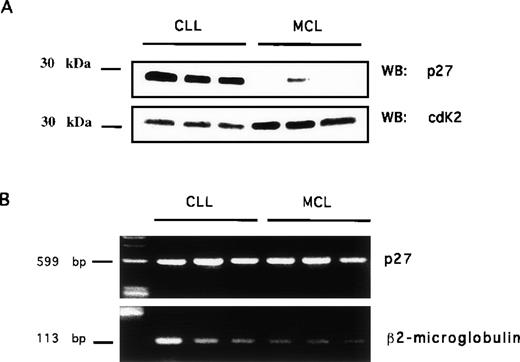 Fig. 3. p27 protein and mRNA expression in CLL and MCL B cells. / Highly enriched neoplastic B cells from patients with CLL and MCL were used to prepare total protein lysates and total RNA (see Material and Methods). Total protein lysates were electrophoresed, blotted, and incubated with anti-p27 (A top row) or with anti-CDK2 (A, bottom row). cDNA transcribed from total RNA was amplified using oligonucleotides recognizing p27 (B, top row) or β2-microglobulin (B, bottom row).