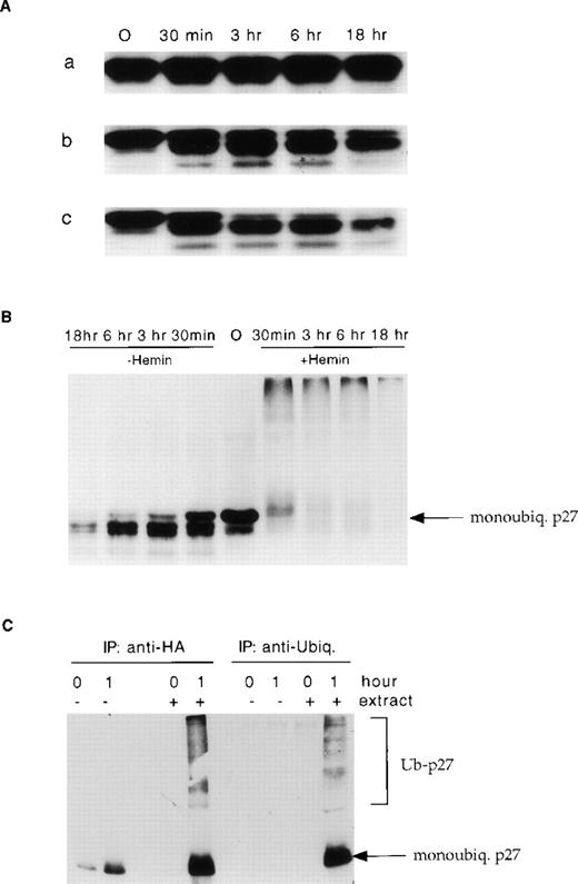 Fig. 4. Kinetics of p27 degradation in MCL. / Purified recombinant p27 was incubated for the indicated intervals with the extracts from three representative MCL cases (a, high p27 expression; b, low expression of p27 by the tumor cells, but the lymphoid tissue sample contained a relative large number of p27+ reactive T cells; c, low expression of p27 by the tumor cells, and the lymphoid tissue sample contained a small number of p27+ reactive T-cells) (A). To demonstrate that p27 degradation is mediated by proteasome the MCL lysates were incubated with and without hemin (B). p27 was polyubiquitinated before proteosome degradation (C). Purified recombinant p27 was incubated for 1 hour with the cell extract (HeLa) in the presence of HA-ubiquitin and subsequently was immunoprecipated with an anti-HA or anti-ubiquitin mAbs. After transfer, polyubiquitinated p27 forms were identified using anti-p27 mAb.