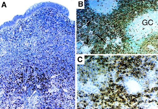 Fig. 3. Expression of CXCR3 in B-cell lymphomas with varying degrees of plasmacytic differentiation. / (A) Low-grade extranodal marginal zone lymphoma (MALT lymphoma) of stomach showing CXCR3 in clusters of plasma cells (white arrows) and not in the majority of infiltrating small lymphocytes. (B) Salivary gland MALT lymphoma with sheets of CXCR3-positive interfollicular “monocytoid” neoplastic B cells. Admixed non-neoplastic follicles and associated mantle zones are negative for CXCR3, as are salivary ducts and glands (black arrows). (C) Diffuse CXCR3 staining in a low-grade MALT lymphoma of the lung with extensive plasmacytic differentiation. Epithelial elements are negative.