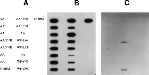 Fig. 1. Detection of N-RAS mutation at codon 13 in peripheral blood cell DNA of patients with AA, AA/PNH, and MDS. / (A) Arrangement of samples on the filter (NORM, normal control). (B) Membrane probed with wild-type (Gly) probe. (C) Membrane probed with combinations of Ser, Cys, and Asp mutant-specific probes. Samples from patient 12 granulocytes (WP-G) and lymphocytes (WP-L) in 1993 (AA/PNH phase) and 1996 (MDS phase) are indicated