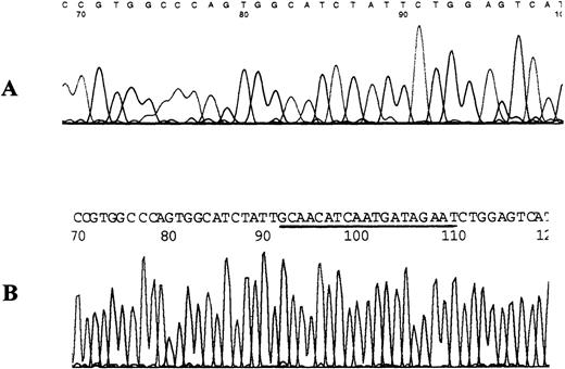 Fig. 2. Nucleotide sequence for the mutant fragment of exon 6 for patient 12. / (A) DNA sequence from patient. Note that 19 bp was deleted from the sequence after the T numbered 90 in this sequencing run. (B) Normal sequence from control DNA. Note that the sequence deleted from the patient's DNA is underlined.
