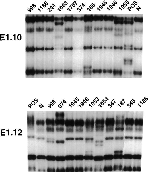 Fig. 1. PCR-SSCP analysis of BCL-6 mutations in representative B-cell neoplasms. / Representative results obtained for PCR-SSCP fragments E1.10 and E1.12 are shown. Samples of B-cell neoplasms are indicated at the top of each lane by a numbered code. A positive control (POS), represented by a tumor sample known to harbor BCL-6 mutations, as well as a normal (N) sample, represented by a lymphoblastoid cell line, are also included for each PCR-SSCP fragment shown. Samples were scored positive when their migration pattern differed from the normal control (N) and the migration abnormalities could not be ascribed to population polymorphisms. Among the samples shown in the figure, cases scored as positive included cases 1063 (primary splenic B-DLCL), 166 (primary extranodal B-DLCL), 1955 (primary central nervous system B-DLCL) for PCR product E1.10, and cases 998 (systemic de novo B-DLCL), 374 (systemic de novo B-DLCL), 1053 (primary splenic B-DLCL), 1054 (primary splenic B-DLCL), and 187 (primary extranodal B-DLCL) for PCR product E1.12.