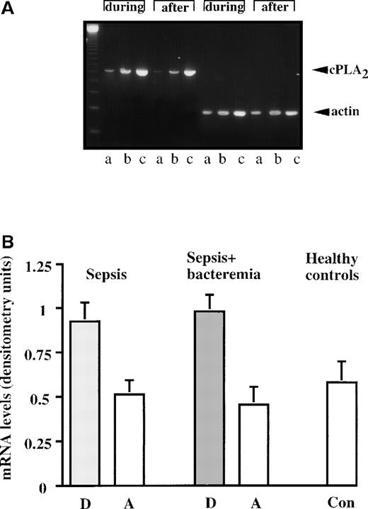 Fig. 3. cPLA2 mRNA levels during sepsis and after recovery. / (A) A representative RT-PCR experiment assessing cPLA2 mRNA levels of a septic patient manifesting elevated cPLA2protein activity and expression. The amplified products of cPLA2 (628 bp) and the corresponding products of β-actin (269 bp) are shown. The PCR reactions were amplified for 25, 35, and 45 cycles (A, B, and C, respectively). The first lane shows the 123 bp size marker. (B) cPLA2 mRNA levels in human neutrophils during sepsis and after recovery. The levels of cPLA2 mRNA in neutrophils of the septic patients with increased cPLA2and the controls were quantitated by densitometry and divided by the corresponding actin mRNA levels. The mean ± SEM of the densitometry analysis in the septic patients and the controls are shown. The densitometric analysis demonstrates that cPLA2 mRNA levels are significantly higher (P < 0.001) during the disease than after recovery.
