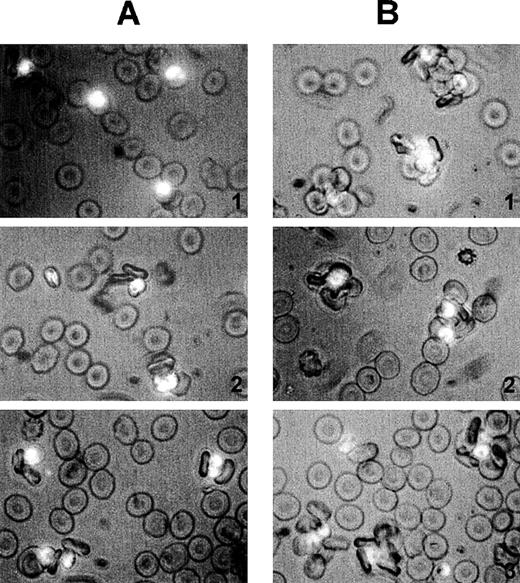 Fig. 3. Size and quality of rosettes are determined by multiple serum components. / Rosettes visualized by immunofluorescence in the presence of ethidium bromide to stain parasite nucleic acid (× 1000 objective in incident ultraviolet light) showing the difference between the effect of individual and combined serum fractions. (A) Small rosettes formed in the presence of individual serum fractions. The adhesion between the cells was weak, and the rosettes sometimes fell apart. Panel 1, conA-unbound fraction, C1; panel 2, anion exchange-unbound fraction, A1; panel 3, IgM affinity-unbound fraction, M1. (B) Large rosettes formed in the presence of whole serum or combined fractions. These rosettes were robust and stable, the interaction between the cells was strong, and the rosettes did not fall apart. Panel 1, conA-unbound fraction C1 + bound fraction C2; panel 2, anion exchange-unbound fraction A1 + gradient fraction GF4; panel 3, IgM affinity-unbound fraction M1 + bound fraction M2 (ie, IgM).