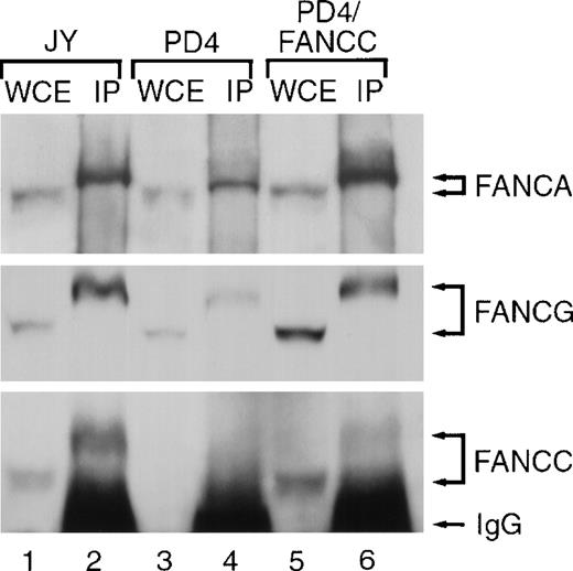 Fig. 1. The differential rate of migration of FANCA, FANCG, and FANCC proteins. / FANCA antiserum immunoprecipitates FANCA and co-precipitates FANCC and FANCG proteins. Whole cell extracts (WCEs) were prepared from lymphoblast lines including: JY (normal), PD4 (Fanconi group C mutant cells expressing no detectable FANCC protein) and PD4/FANCC (isogenic PD4 cells complemented with normal FANCC cDNA). Extracts (100 μg) were electrophoresed either without prior manipulation (lanes 1, 3, and 5) or following immunoprecipitation (IP) (3 mg for each sample) using affinity purified anti-FANCA anti-serum (lanes 2, 4, and 6). Fanconi anemia proteins in each lane were detected on immunoblots with affinity purified anti-FANCA, anti-FANCC, and anti-FANCG serum as indicated.