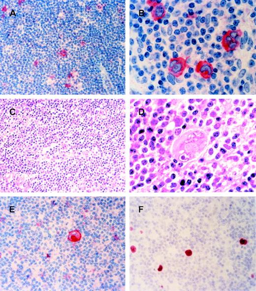 Fig. 1. Three cases of B-CLL with intermingled HRS-like cells. / (A, B, E) Anti-CD30 antibody staining of cases 1-3, hematoxylin counterstain. Single CD30-positive HRS-like cells are interspersed in the B-CLL infiltrated lymph node. (A) Case 1, 200 × magnification. (B) Case 2, 1000 × magnification. (E) Case 3, 400 × magnification. (C) Hematoxylin-eosin staining of case 2. The infiltrate mainly comprises small lymphocytes, a few blast cells, and histiocytes. A Reed-Sternberg–like cell is seen in the middle of the picture, 200 × magnification. (D) Hematoxylin-eosin staining of case 2. A Reed-Sternberg cell surrounded by small lymphocytes and histiocytes is seen in the middle of the picture, 1000 × magnification. (F) In situ hybridization of frozen section from CLL-infiltrated lymph node of case 3 for EBER-RNA. The HRS-like cells carry EBER-RNA, 400 × magnification. (A-F) Sections of formalin-fixed, paraffin-embedded, or frozen tissue.