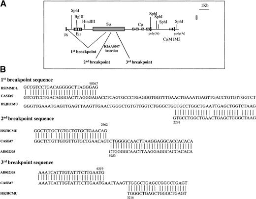 Fig. 6. Graphic representation of the 3 breakpoints in case No. 7. / (A) The 3′Sμ aberrant fragment was amplified by long-distance inverse PCR. Genomic DNA from case No. 7 was digested with EcoRI, was self-ligated, and long-distance inverse PCR was performed using 4 primers (3MFA, 3MRA, 3MFB, 3MRB) internal to the 3′Sμ region. The 3 breakpoints are generated by a deletion from downstream JH6 to the middle of the Sμ region and by an insertion of a chromosome 15 gene (KIAA0307) into the Sμ region. Eμ = intronic enhancer, Sμ = switch μ region, Cμ = constant μ exons, M1, M2 = exons for membrane form. (B) Alignment of the breakpoint regions of case No. 7 with germline GenBank sequences. Numbers indicate the nucleotide position at which the breakpoint occurred within the corresponding GenBank sequence. These sequences are available from GenBank under accession numbers AF156 533, AF156 534, and AF156 535. HSIMMDL = GenBank DNA sequence of the human immunoglobulin D segment locus, HSJHCMU = GenBank nucleotide sequence of the IgH Sμ region, AB002 305 = GenBank nucleotide sequence of human mRNA for KIAA0307 gene.