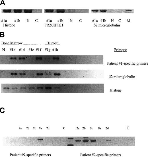 Fig. 3. MM-engrafted mice have BM cells and spleen cells expressing human β2-microglobulin, IgH VDJ and clonotypic transcripts. / Each lane represents femoral bone marrow or vertebral tumor from an individual mouse. The numerical designation indicates the patient from whom the injected cells were obtained. (A) Bone marrow (femur) from mice engrafted with cells from patient 1. RNA from the indicated tissues was amplified in RT-PCR using the indicated primers. Histone primers detect both human and mouse transcripts. Primers for human β2 microglobulin detect only human transcripts. n = uninjected NOD SCID: C = water control. (B) Clonotypic transcripts in RNA of engrafted mice. A second set of tissues from individual mice, were tested for histone, β2 microglobulin and clonotypic transcripts in nested RT-PCR using first primers to FR2/Jh in the first stage and patient 1-specific primers for CDR2/CDR3 in the second stage. Each lane represents femoral BM, or a vertebral tumor from an individual mouse injected with cells from patient 1. (C) Patient-specific primers are specific. Patient-specific primers for patients 2 and 9 were tested in a crisscross specificity experiment. Each lane represents femoral BM cells from an individual mouse injected with either cells from patient 2 or 9. RNA from each mouse was amplified in nested RT-PCR using FR2/Jh primers, followed by CDR2/CDR3 primers specific for either patient 2 or 9. Because the PCR products are patient-specific, the size of the product varies with each individual patient.
