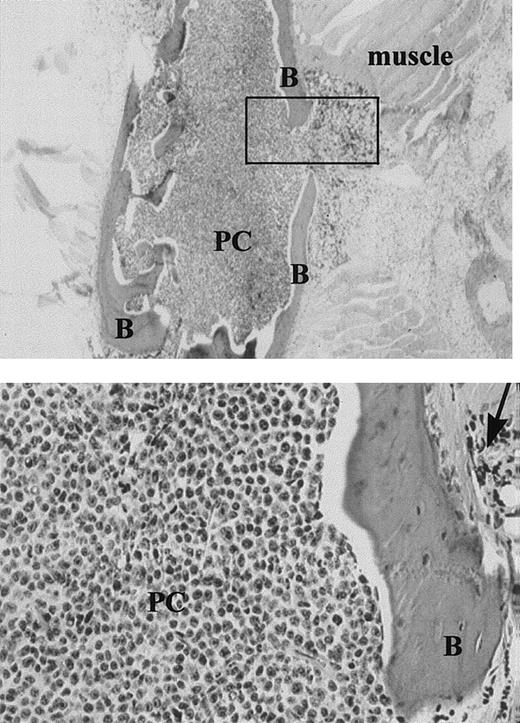 Fig. 4. Expansile bone lesion in the sternum of an MM-engrafted mouse injected IC with ex-vivo human MM cells (× 20). / Upper panel: The box indicates the expansile bone lesion. B = bone, PC = human plasma cells. Lower panel: Higher power view of the expansile lesion (× 100), arrow = expansile lesion. Sequential sections were stained with antihuman kappa chain, or antihuman lambda. All the plasma cells, which were derived from a patient with IgK myeloma, were strongly positive for kappa. None stained with antilambda.