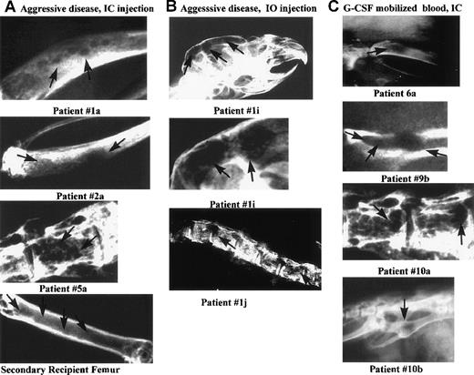 Fig. 5. Lytic bone lesions in the skull, tibia, pelvis, or spine of 10 MM-engrafted mice. / Carcasses of 56 engrafted mice killed at preterminal disease stages, and 12 control mice, were radiographed using mammography. Ten representative radiographs of bones from MM-engrafted mice that had lytic lesions are shown here. The comparable bones from either irradiated or normal control mice did not have detectable lesions (not shown). Each panel is labeled with the source of the engrafting cells and the route of injection. Arrows indicate lytic lesions. The panels are labeled with the patient number from whom the engrafting MM cells were derived (A) Diseased bones (tibias or vertebral body) from mice engrafted IC with aggressive MM cells, or from a secondary recipient mouse (femur). (B) Diseased bones from mice injected IO with aggressive myeloma cells (skull or spine). The middle panel is an enlarged image of the skull lesions. (C) Diseased bones from mice engrafted IC with G-CSF mobilized blood cells (tibia, pelvis, vertebral body, pelvis).