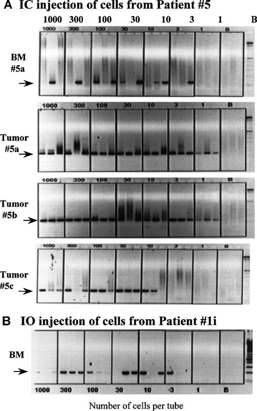 Fig. 6. Clonotypic cells are frequent in the BM of MM-engrafted mice. / Mice engrafted IC with cells from patient 5 (A), and a mouse injected IO into the sternum with cells from patient 1 (B) were killed at the time of end stage disease, followed by harvest of the femoral bone marrow. The number of clonotypic cells engrafting the femurs was determined by a cellular limiting dilution RT-PCR, as described in “Materials and Methods.” In a replicate dilution series, primers to histone were used to determine the number of tubes having intact mRNA. For patient 5, tumors from 3 different engrafted mice were dispersed through a sieve and the cells deposited at limiting dilution into PCR tubes; the phenotypic analysis of the tumor from mouse 5a is shown in Figure 1. Because the PCR is a direct lysis method, aliquots having 1000 cells per tube sometimes exhibit less PCR product that tubes having fewer cells, presumably because of cellular proteins compromising the PCR reaction. The extent to which this occurs appears to depend on the source of cells being deposited into the tubes.
