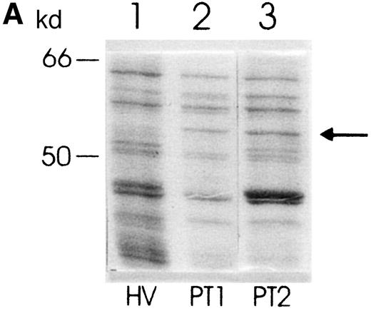 Fig. 1. Protein expression in PMNs from PT patients and healthy volunteers. / (A) Coomassie blue–stained SDS-polyacrylamide gel showing protein pattern of lysates (10 μg per lane) from PMNs from a healthy volunteer (lane 1) and 2 PT patients (lanes 2 and 3). The arrow indicates the additional band in lanes 2 and 3. (B) Western blot showing expression of PK in PMNs from a healthy volunteer (lane 1) and a PT patient (lane 2).