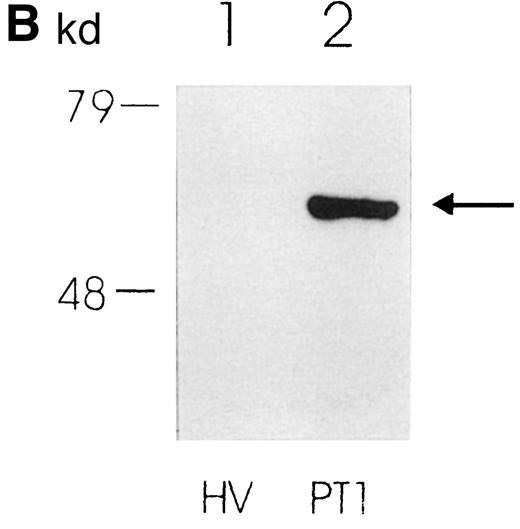 Fig. 1. Protein expression in PMNs from PT patients and healthy volunteers. / (A) Coomassie blue–stained SDS-polyacrylamide gel showing protein pattern of lysates (10 μg per lane) from PMNs from a healthy volunteer (lane 1) and 2 PT patients (lanes 2 and 3). The arrow indicates the additional band in lanes 2 and 3. (B) Western blot showing expression of PK in PMNs from a healthy volunteer (lane 1) and a PT patient (lane 2).