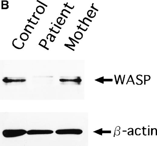 Fig. 1. WASP expression in 3 subjects. / (A) Flow cytometric analysis of WASP expression in normal individual (control), XLT patient (patient), and his mother (mother). The shaded areas and the dashed line indicate the staining with anti-WASP and control antibodies, respectively. (B) A Western blot analysis of WASP protein in the lysates from the 3 subjects above. WASP and β-actin protein as internal control were determined as approximately 59 kD and 42 kD proteins, respectively.