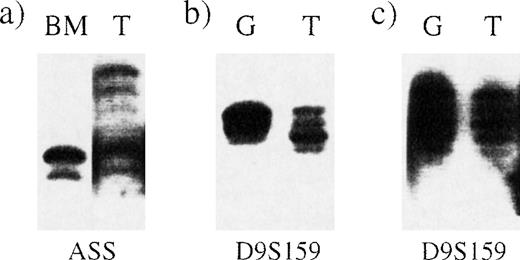 Fig. 3. Deletions detectable by microsatellite PCR in bone marrow and peripheral blood granulocytes. / Microsatellite PCR was performed on samples from 3 different Ph-positive patients by using primers for the loci indicated below each panel. BM indicates bone marrow; G, granulocytes; and T, T cells. (A) Loss of heterozygosity at the ASS locus in bone marrow from patient 5. (B) Loss of heterozygosity at the D9S159 locus in peripheral blood granulocytes from patient 3. (C) No loss of heterozygosity at the D9S159 locus in granulocytes from a patient with no detectable deletion.