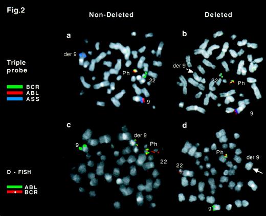 Fig. 2. FISH analysis of Ph-positive metaphase cells. / (A) Triple-probe/3-color signal pattern observed in a Ph-positive metaphase cell with no detectable deletion of chromosome 9 sequences.ABL is in red, BCR in green, and ASS in blue. A colocalized red/green signal marks the Ph chromosome, the der(9) chromosome is identified by a single blue signal, the normal 22 by a green signal, and the normal 9 by a blue/red doublet. (B) Triple-probe/3-color signal pattern in a Ph-positive metaphase cell with a deletion of chromosome 9 sequences. The der(9) chromosome does not show a blue ASS signal (arrow). (C) D-FISH signal pattern in a Ph-positive metaphase cell with no detectable loss of chromosome 9 or 22 sequences. ABL is in green and BCR in red. A colocalized red/green signal marks both the Ph and der(9) chromosomes, a green signal identifies the normal 9, and a red signal marks the normal 22. (D) D-FISH signal pattern in Ph-positive metaphase with loss of sequences from chromosome 9 and 22. ABL is in green andBCR in red. There is a colocalized red/green signal on the Ph chromosome but not on the der(9) (arrow).