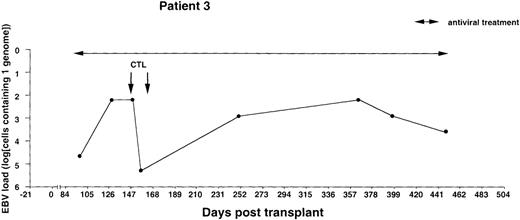 Fig. 3. Monitoring of EBV-DNA load in patient 3. / A 10-year-old boy with T-cell ALL received a TCD bone marrow graft from a mismatched unrelated donor. The early posttransplant course was uncomplicated. Intravenous infusions of foscarnet were given during the entire observation period because of detection of CMV-DNA in leukocytes and leukopenia. The majority of circulating T cells were of recipient origin during the first 3 months after BMT, whereas B cells, macrophages, and granulocytes were of donor origin as determined by PCR. Donor T cells were infused on days +62 and +82, and only donor T cells were detected in the circulation 6 months after BMT. Two infusions of 107/m2 EBV-CTLs were given on day +148 and +160. There were no clinical signs of GVHD after T-cell infusions or EBV-CTL treatment. Cyclosporin A was discontinued 9 months after BMT. The T-cell leukemia relapsed 16 months after BMT, with a lethal outcome.