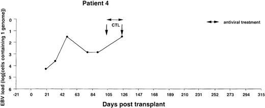 Fig. 4. Monitoring of EBV-DNA load in patient 4. / A 5-year-old boy with HLH received a TCD bone marrow graft from a mismatched unrelated donor. The early posttransplant course was uncomplicated, without clinical signs of GVHD. Despite the successful engraftment of BMT, repeated infusions of donor T cells, and a booster of peripheral stem cells, recipient T cells persisted in the blood. Lymphopenia and positive PCR tests for CMV-DNA in the blood prompted preemptive antiviral therapy. EBV-CTLs were infused on days +102 and +125, at which time the patient presented with fever and abdominal pain. A bilateral neck mass developed rapidly, and an excisional biopsy performed on day +140 disclosed a highly malignant EBV-positive NHL with dissemination to the abdomen and central nervous system. The patient died of progressive disease 2 weeks after diagnosis.