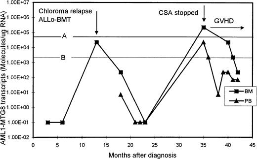 Fig. 3. Serial quantitation of AML1-MTG8 transcripts in BM and PB in a patient presenting with chloroma and AML. / A and B are the upper limits of RIRT in BM and PB, respectively. Levels of 1.00E-01 are RT-PCR negative.