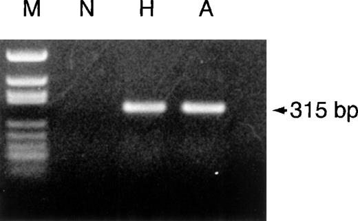 Fig. 4. PCR amplification of the junction region of theHpdel from a control individual (N), hypohaptoglobinemia (H) and anhaptoglobinemia (A). / PCR products underwent electrophoresis in a 1.2% agarose gel and were stained by ethidium bromide. The size of the PCR product is indicated.MspI-digested pBluescript (M) was used as a molecular size marker.