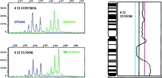 Fig. 1. Amplification of the 3q27 region as detected with the D3S1311 microsatellite marker and confirmatory CGH for chromosome 3 in patient 22. / Control and tumor DNA samples were amplified with markers D3S1311 located in the 3q27 region and D7S496 used as an internal control in a multiplex PCR reaction, and the ratios of the alleles determined. CGH profile of chromosome 3 of the same patient is shown on the right side. The cut-off values for losses (0.80) and gains (1.25) are depicted as blue and magenta lines, respectively.