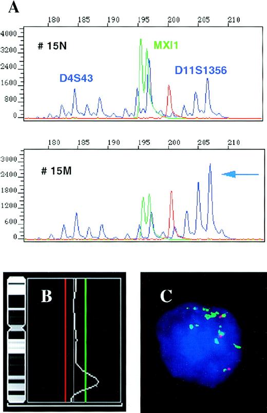 Fig. 2. High-level amplification of the 11q23-24 region containing the MLL gene locus in patient 15. / (A) Results of a multiplex PCR for repeats D4S43 and MXI1 used as an internal control and microsatellite D11S1356 located in the MLL gene region. The individual amplificates show decreasing signal with increasing product size in reaction 15 M (tumor) as compared with 15 N (control); however, the 208 bp allele of the D11S1356 does not follow this pattern and its signal is actually increased. Comparison of the D11S1356 208/198 bp allele ratios in the normal and tumor tissues, 0.7 and 3.09, respectively, shows an increase of the 208 bp allele signal by 341% in the tumor. (B) CGH results for chromosome 11 performed with the same tumor DNA showing high-level amplification of the 11q23-24 region. The cut-off values for losses (0.80) and gains (1.25) are depicted as red and green lines, respectively. (C) Interphase FISH assay performed with the YAC clone 785c6 (green) localized to the MLL gene locus and the control YAC 878c12 (red) assigned to 11q21, showing multiple copies of the MLL gene region. The patient was tetraploid, the fourth signal associated with the control YAC is out of focus.