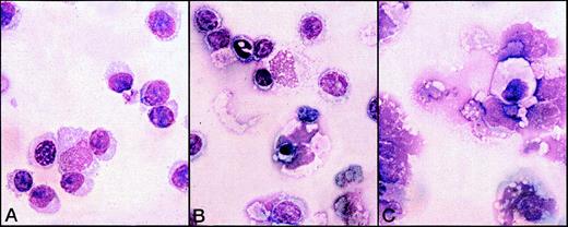 Fig. 7. Morphological analysis of B-CLL cells exposed to various stimuli for 5 days in vitro. / B-CLL cells (patient B) were exposed to Gaδ-ab + rIL2 (A), rIL2 alone (B), or Gaμ-ab + rIL2 (C). Plasmablasts and plasma cells were observed after culture with Gaδ-ab + rIL2. In contrast, the cells treated with Gaμ-ab were primarily apoptotic or necrotic. Necrosis occurred after apoptosis probably because of the prolonged time in culture (see also Figure 2C). In the preparations exposed to rIL2 only, there were a few surviving small lymphocytes.