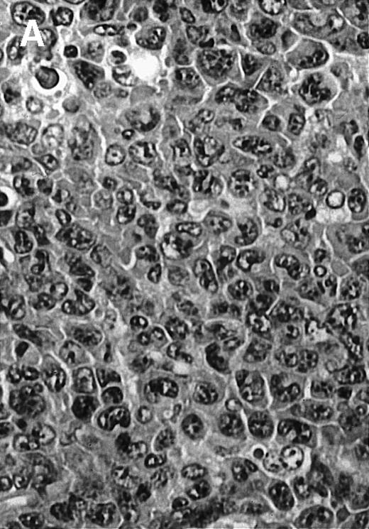 Fig. 4. Histologic analysis of A20 tumors excised 21 days postchallenge from BALB/c mice immunized with ST40L. / (A) HE stain of a BCL region in a mouse treated with PBS alone. (B) HE stain of a smaller BCL region in a mouse treated with ST. (C) HE stain of a small hard nodule at the SC injection site in a mouse treated with ST40L. (D) Fas ligand staining of a BCL region in a mouse treated with PBS alone. (E) Fas ligand staining of a BCL region in a mouse treated with ST. (F) Fas ligand staining of a small hard nodule at the SC injection site in a mouse treated with ST40L. Original magnifications are ×400.