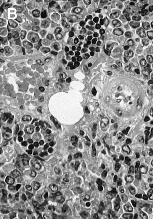 Fig. 4. Histologic analysis of A20 tumors excised 21 days postchallenge from BALB/c mice immunized with ST40L. / (A) HE stain of a BCL region in a mouse treated with PBS alone. (B) HE stain of a smaller BCL region in a mouse treated with ST. (C) HE stain of a small hard nodule at the SC injection site in a mouse treated with ST40L. (D) Fas ligand staining of a BCL region in a mouse treated with PBS alone. (E) Fas ligand staining of a BCL region in a mouse treated with ST. (F) Fas ligand staining of a small hard nodule at the SC injection site in a mouse treated with ST40L. Original magnifications are ×400.