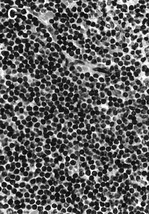 Fig. 4. Histologic analysis of A20 tumors excised 21 days postchallenge from BALB/c mice immunized with ST40L. / (A) HE stain of a BCL region in a mouse treated with PBS alone. (B) HE stain of a smaller BCL region in a mouse treated with ST. (C) HE stain of a small hard nodule at the SC injection site in a mouse treated with ST40L. (D) Fas ligand staining of a BCL region in a mouse treated with PBS alone. (E) Fas ligand staining of a BCL region in a mouse treated with ST. (F) Fas ligand staining of a small hard nodule at the SC injection site in a mouse treated with ST40L. Original magnifications are ×400.