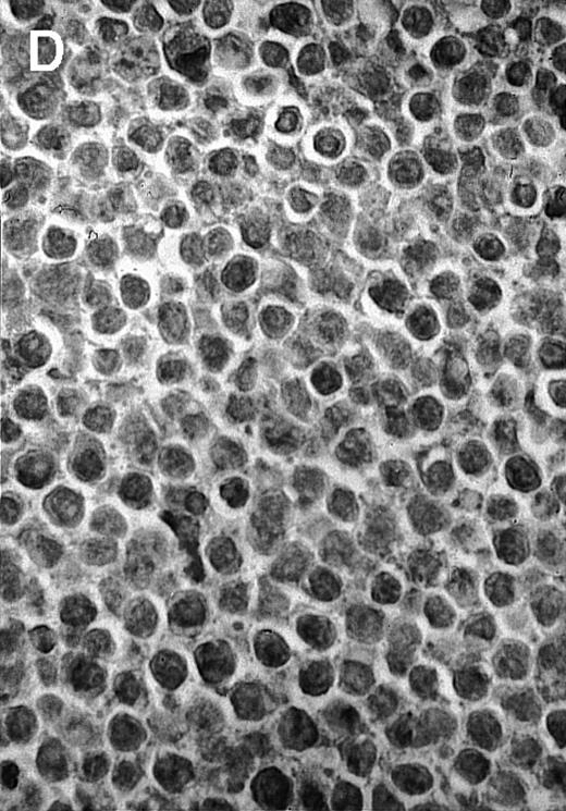 Fig. 4. Histologic analysis of A20 tumors excised 21 days postchallenge from BALB/c mice immunized with ST40L. / (A) HE stain of a BCL region in a mouse treated with PBS alone. (B) HE stain of a smaller BCL region in a mouse treated with ST. (C) HE stain of a small hard nodule at the SC injection site in a mouse treated with ST40L. (D) Fas ligand staining of a BCL region in a mouse treated with PBS alone. (E) Fas ligand staining of a BCL region in a mouse treated with ST. (F) Fas ligand staining of a small hard nodule at the SC injection site in a mouse treated with ST40L. Original magnifications are ×400.