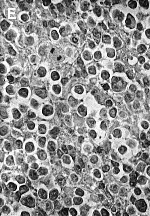 Fig. 4. Histologic analysis of A20 tumors excised 21 days postchallenge from BALB/c mice immunized with ST40L. / (A) HE stain of a BCL region in a mouse treated with PBS alone. (B) HE stain of a smaller BCL region in a mouse treated with ST. (C) HE stain of a small hard nodule at the SC injection site in a mouse treated with ST40L. (D) Fas ligand staining of a BCL region in a mouse treated with PBS alone. (E) Fas ligand staining of a BCL region in a mouse treated with ST. (F) Fas ligand staining of a small hard nodule at the SC injection site in a mouse treated with ST40L. Original magnifications are ×400.