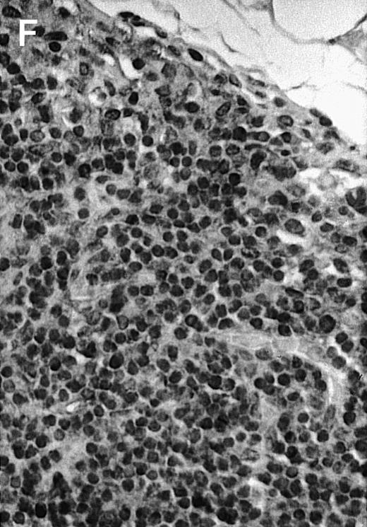 Fig. 4. Histologic analysis of A20 tumors excised 21 days postchallenge from BALB/c mice immunized with ST40L. / (A) HE stain of a BCL region in a mouse treated with PBS alone. (B) HE stain of a smaller BCL region in a mouse treated with ST. (C) HE stain of a small hard nodule at the SC injection site in a mouse treated with ST40L. (D) Fas ligand staining of a BCL region in a mouse treated with PBS alone. (E) Fas ligand staining of a BCL region in a mouse treated with ST. (F) Fas ligand staining of a small hard nodule at the SC injection site in a mouse treated with ST40L. Original magnifications are ×400.