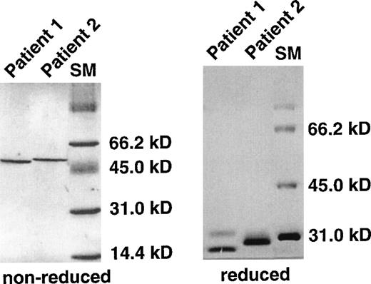 Fig. 1. SDS-PAGE analysis of recombinant, lymphoma-derived Fab fragments. / Immunoglobulin transcripts from lymphoma biopsies of both patients were amplified by PCR, sequenced, and inserted into pFab.γκ. Recombinant Fab fragments were expressed from pFab.γκ vectors in E. coli. Periplasmic fractions of induced bacteria were prepared and purified by affinity chromatography. The resultant protein eluate was analyzed by standard 12% SDS-PAGE under reducing and nonreducing conditions. Protein bands were visualized by silver staining. The Fd and IgL chains of patient 2 had almost identical migration properties under reducing conditions. Even when the gel was run with 6 mol/L urea, the separation of the bands could not be improved (not shown). SM, high-molecular weight marker.