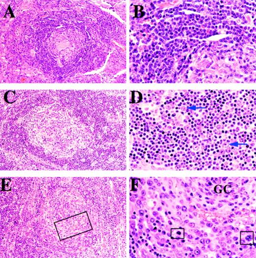 Fig. 1. Cases 19, 7, and 8. / (A) and (B): A lymph node from case 19 shows features of plasma cell variant CD (panels A and B). (A) Follicle comprises a hyalinized germinal center surrounded by a broad mantle. (B) High magnifcation showing uniform population of small lymphocytes in the mantle zone. (C) and (D): A lymph node from case 7, an HIV-positive patient, shows features of plasmablastic variant CD. (C) The follicle comprises a partially hyalinized germinal center surrounded by a well-formed mantle. (D) High magnification of mantle zone showing small lymphocytes and scattered transformed plasmablasts, 2 of which are arrowed. (E) and (F): A lymph node from case 8, an HIV-positive patient with plasmablastic CD. (E) The follicle shows a poorly defined mantle zone that is partially replaced by a concentric infiltrate of plasmablasts. (F) High magnification of area within the rectangle in Figure 1E, showing the germinal center (GC) surrounded by plasmablasts that have replaced the mantle. Some cells in mitosis are highlighted in squares.