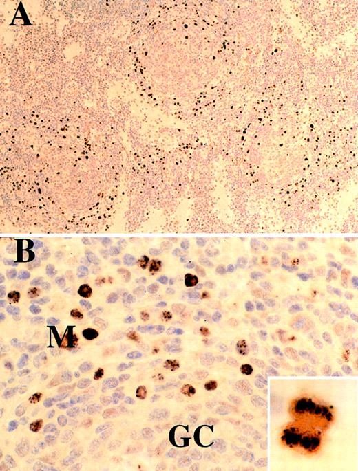 Fig. 2. Case 10, lymph node from an HIV-negative patient stained for HHV-8. / (A) Low magnification showing mantle zone distribution of HHV-8–positive cells. (B) High magnification showing stippled and/or diffuse nuclear staining. Inset shows a cell in mitosis; there is localization of HHV-8 DNA to chromosomes by antiLNA antibody.