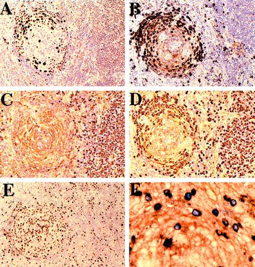 Fig. 3. Cases 8 and 10. / (A-E): Case 8. Follicle and interfollicular plasma cells stained (A) for HHV-8, (B) for μ heavy chain, (C) for κ light chain, (D) for λ light chain, and (E) with Ki-67. The mantle zone plasmablasts show nuclear positivity for HHV-8, express μ heavy chain, and show λ light-chain restriction, while the μ negative interfollicular plasma cells are polytypic with respect to light chains. Most, if not all, of the plasmablasts are in cycle. (F) Case 10. Mantle zone immunoblasts double-stained for HHV-8 (blue) and λ light chain (brown). HHV-8–positive nuclei are exclusively within λ-positive cells.