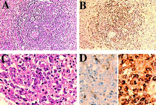 Fig. 4. Case 1. / Section of spleen showing (A) a microlymphoma surrounding a splenic arteriole comprising (B) HHV-8–positive cells with (C) plasmablastic morphology. (D) Immunostain for κ (left) and λ (right); there is λ light-chain restriction.