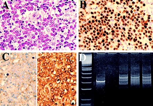 Fig. 5. Case 5. / (A) Lymph node showing frank plasmablastic lymphoma, (B) immunostained for HHV-8 and (C) for κ (left) and λ (right) light chains. The HHV-8–positive lymphoma cells show λ light-chain restriction. (D) Polyacrylamide gel electrophoresis of immunoglobulin heavy-chain gene PCR products. Lane 1: PhiXHinfI molecular weight markers (the marker band immediately below the positive control band is 82bp variant CD). Lane 2: positive control B-cell lymphoma. Lane 3: negative control (no DNA). Lanes 4, 5, and 6: repeat amplifications of DNA showing a reproducible dominant band indicating an expanded clone.