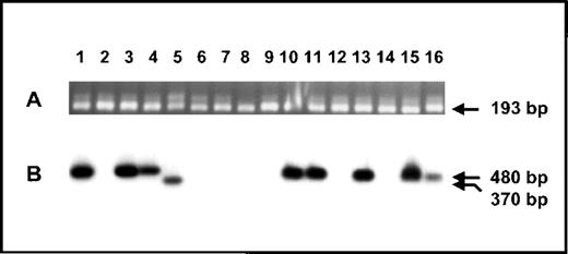 Fig. 8. Expression of human survivin mRNA forms. / Prior to separation by agarose gel electrophoresis, nested RT-PCR was performed on mRNA derived from the following human cell lines and tissues: 1. K562 leukemia cell line; 2. Jurkat T-cell line; 3. germ-cell tumor derived cell line; 4. teratocarcinoma cell line; 5. neuroblastoma cell line; 6-9. malignant tumor from patients with MALT lymphoma; 10. AS19 melanoma cell line; 11. Del leukemia cell line; 12. SW620 colon cancer cell line; 13. Hep3B hepatoma cell line; 14. Ht1080 neurofibrosarcoma cell line; 15. A431 carcinoma cell line; 16. Raji leukemia cell line. (A) Ethidium bromide-stained agarose gel of nested RT-PCR products generated with oligonucleotide primers hsrv2861 and hsrv5431. Transcripts correspond to full-length murine survivin140. (B) Southern blot using32P-labeled hsrv2888 to detect specific nested RT-PCR products generated using oligonucleotide primers hsrv2861 and hsrv5159. Several cell lines express the specific transcript corresponding to murine survivin121, whereas only the neuroblastoma cell line expresses a transcript corresponding to murine survivin40.
