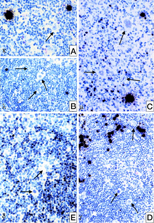 Fig. 1. Detection of Ig heavy and light chain transcripts in classical HD by in situ hybridization using radioactively labeled probes for the according constant region. / (A) IgL kappa; (B) IgL lambda; (C) IgH mu; (D) IgH delta; (E) IgH gamma. HRS cells are negative for all types of Ig expression (→) whereas plasma cells are intensively labeled; normal B-cells are weakly or moderately positive.