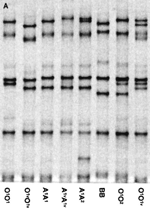 Fig. 1. Multiplex PCR-SSCP analysis for the determination of the ABO genotypes. / (A) The SSCP banding patterns for homozygotes (for O1, O1v, A1, A1v, and B) and heterozygotes (for less common alleles A2 and O2). (B) Schematic drawing showing the standard SSCP banding patterns for the 7 common ABO alleles, together with their designations. Note that the homozygous patterns for A2 and O2 are deduced from the heterozygous patterns. For alleles B and O2, the weakly stained fastest-moving band of the F1 fragment overlaps with the strongly stained slowest-moving band of the F3 fragment marked by asterisk (*). (C) The SSCP banding patterns for representative samples containing rare alleles, together with some common phenotypes (O1O1v and A1A2) for comparison. The rare alleles are designated as Av1, and Ov1 to Ov7.