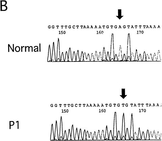 Fig. 1. Detection of IVS4 mutation by PCR-SSCP and subsequent direct sequencing. / (A) Representative PCR-SSCP analyses using the primer set for exon 4 boundaries. 4510C cells are homozygous for the IVS4 mutation; FA239 cells are heterozygous (IVS4/wt) for this segment; and N indicates normal control. The patient numbers correspond to those in Table 1. Arrowheads indicate mobility shifts of the PCR products from the genomic DNA from the patients, P1, P2, P3, P4, P5, and P6. (B) Representative sequencing results. Direct sequencing of aberrant bands from P1 identified an A to T transition of the fourth base in intron 4 (indicated by arrows).