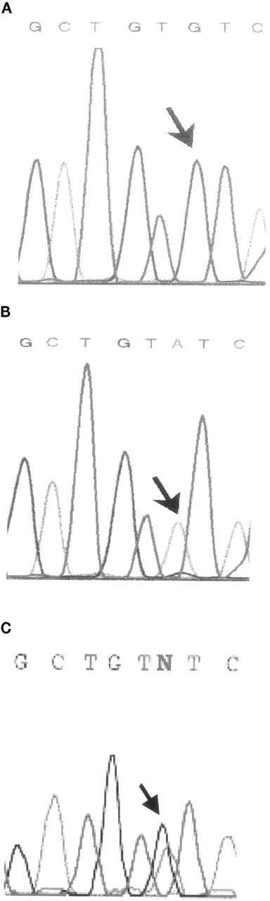 Fig. 2. Extract of direct sequencing of exon 8. / (A) Normal sequencing histogram. (B) Patient's peripheral blood histogram with a small G peak. (C) Patient's buccal cell histogram with a normal G peak greater than a mutated A peak.