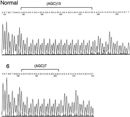 Fig. 1. Sequencing of the mutated E2F4 gene. / Only the (AGC)13 tract and flanking regions of the E2F4 gene are indicated. Sample 6 (acute ATL) shows a mutant nucleotide sequence.