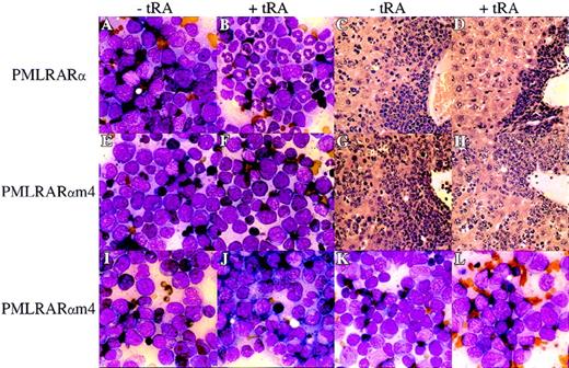 Fig. 5. Retinoic acid response of PMLRARm4 leukemias. / Leukemic mice were treated with placebo (A, C, E, G, I, K) or tRA (B, D, F, H, J, L). (A-D) PMLRARα expressing leukemia. (E-H)PMLRARαm4 leukemia 4099. (I-J) PMLRARαm4 leukemia 4042. (K-L) PMLRARαm4 leukemia 4048.2. (A, B, E, F, I-L) Bone marrow, Wright's Giemsa stain, 350 × . (C, D, G, H) Liver, Hematoxylin and eosin stain, 140 × . Effects of 11 days of tRA therapy are shown.