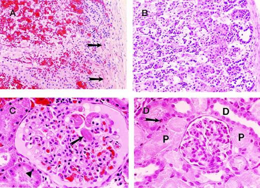 Fig. 3. Photographs of sections of adrenal and kidneys from baboons injected with sublethal doses of E coli and blocking anti-EPCR mAbs. / The organs were harvested at the time of impending death. The “early” changes (ie, changes in animals with relatively short survival) consist of prominent microthrombus formation in the subcapsular vessels (arrows) of the adrenals (A) and also in the renal glomeruli (arrow) (C). Note the extensive cortical hemorrhage in the adrenal gland (A) and the early ischemic/necrobiotic changes (karyopyknosis) in the proximal tubular epithelial cells (triangle) of the kidney (C). In B and D, the animals that had relatively long survival, widespread necrotic foci were apparent with associated polymorphonuclear leukocyte infiltrates in the adrenal cortex (B) and severe acute tubular necrosis involving the proximal tubules (P) of the kidney (D). The distal tubules (D) were well-preserved. Occasional mitotic figures of the proximal tubular epithelial cells are also seen as features of regeneration (arrow) (D). Note the lack of thrombi and hemorrhage in the “late” group (B and D).