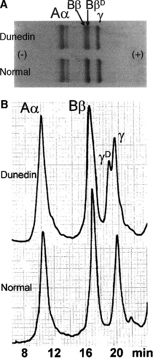 Fig. 1. Analysis of purified fibrinogen. / Fibrinogen from Dunedin plasma is shown in comparison with normal fibrinogen. (A) Analysis by SDS-PAGE (7.5% reducing gel). Note additional BβD band. (B) Analysis by reverse phase HPLC. Note new γD peak.