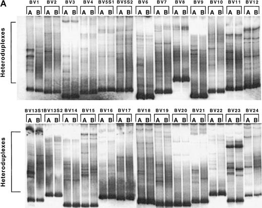 Fig. 3. Changes in the levels of T-cell oligoclonality following induction of HAART during primary HIV infection. / The level of oligoclonality was determined for each TCRBV family by using HMA, as described.28 (A) HMA gel hybridized with Cβb- and Cβc-carrier–specific probes showing variations in heteroduplex patterns for 26 TCRBV families and subfamilies in patient 1166, prior to and after initiation of HAART. (B) Computerized densitometric analysis of the HMA autoradiogram shown in panel A. Triangles indicate discrete TCRBV heterocomplexes detected over the HMA profiles with the use of automated peak discrimination as described in “Materials and methods.” TCRBV heterocomplex patterns prior to (TCRBV A) and after (TCRBV B) therapy for each β chain V-region family from patient 1166 are shown. The actual number of peaks detected appears in the bottom right corner. (C) Summary of clonality analysis in patients 1166, 1168, 1155, and 1192. Numbers of detectable clonotypes are shown prior to and after the introduction of HAART, while the decrease (closed boxes), stability (shaded boxes), or increase (open boxes) in the levels of oligoclonality of respective TCRBV families is indicated; nd indicates not done. Nomenclature of TCRBV families is according to Arden et al.31